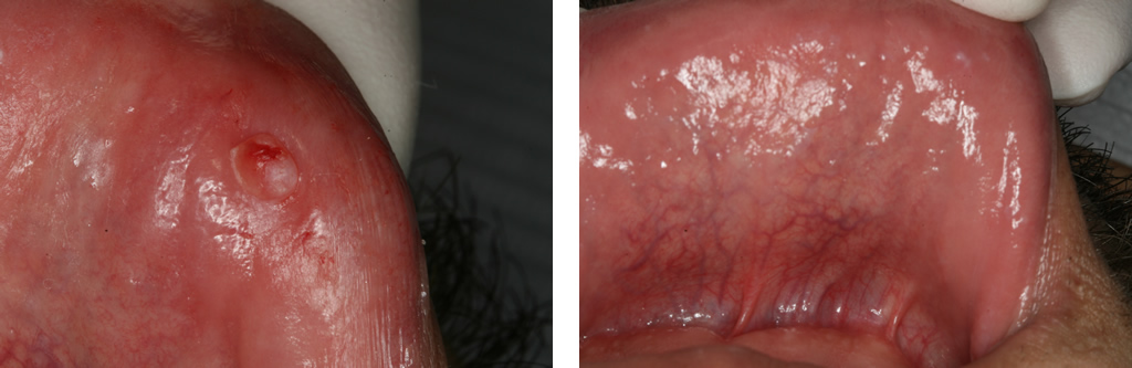 Biopsy